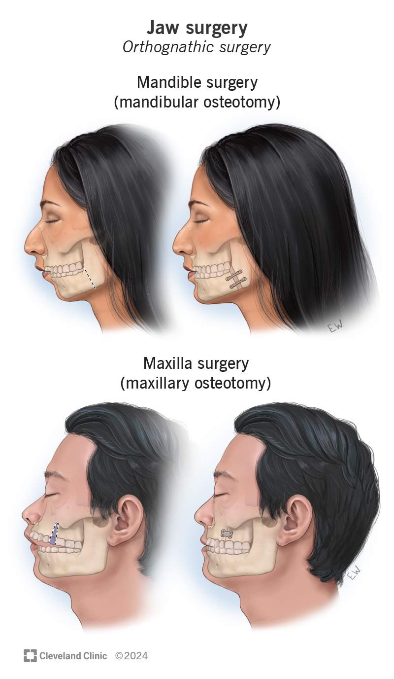 double jaw surgery before and after 1758809382